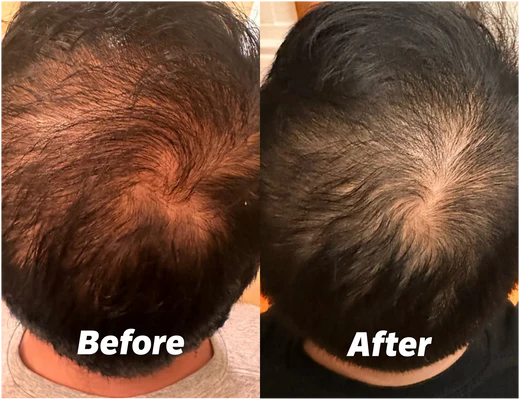 "FEEL CONFIDENT WITHOUT A HAT!"